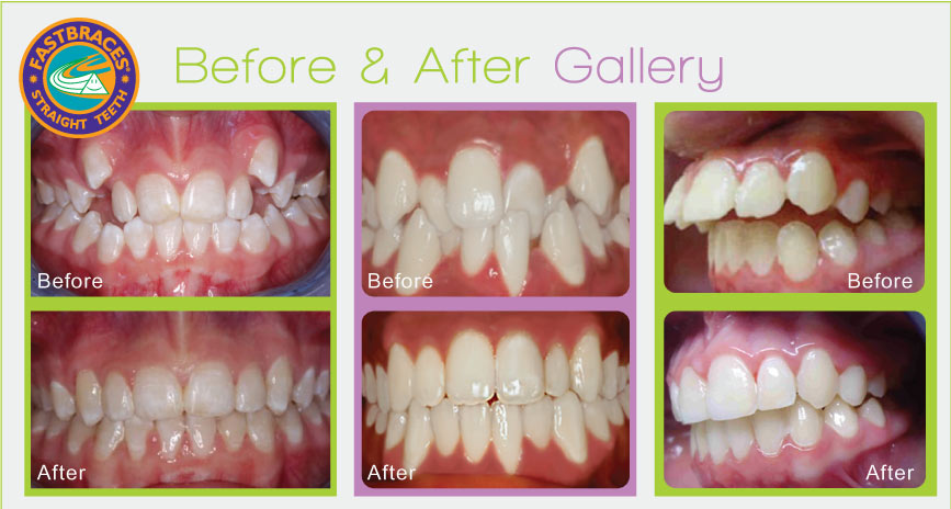 The practice's complete Fastbraces gallery: three cases, with before photos above and after photos below.